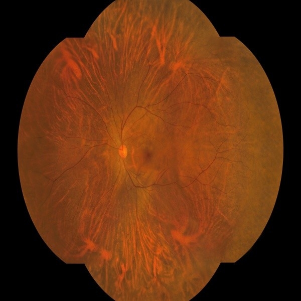 176° Wide Field Fundus Kamera mit KI-Intelligenten System und einer Schlüsseloperation für nicht-mydriatische einzelne Farbbildgebung