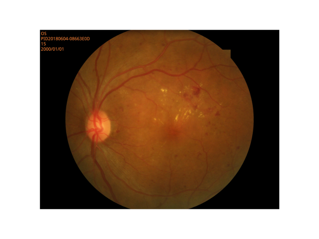 Netzhautdarstellungs-Digital-Fundus-Kamera-kleine Schüler-Modus-hohe Auflösung